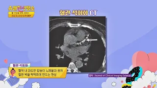 칼슘 보조제를 과하게 섭취할 경우 생기는 혈관 석회화😩 유쾌한 상담소(sangdamso) 22회 | JTBC 220405 방송