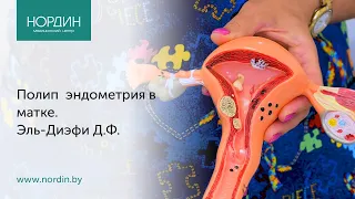 Полип эндометрия в матке