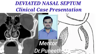 DEVIATED NASAL SEPTUM  Clinical Case Presentation