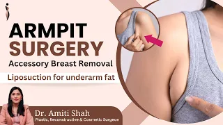 What is Accessory Breast Tissue (Armpit Lump)? Treatment for Accessory Breast Tissue? Dr. Amiti Shah