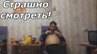 Цирроз в 30 лет! //показал осложнения  ужас! // одной ногой в магиле