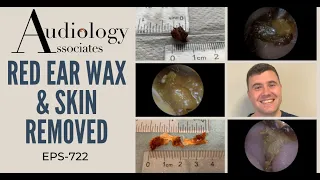 RED EAR WAX & SKIN REMOVED - EP722