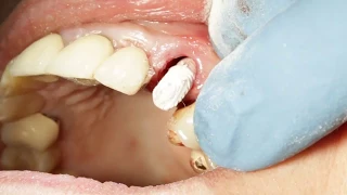 Immediate Provisional Using Peek Temp Abutment