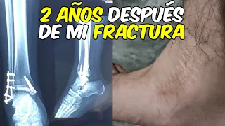 2 AÑOS DESPUÉS DE UNA FRACTURA DE TOBILLO TIBIA Y PERONÉ/¿CUÁNTO TARDE EN CAMINAR? REGRESO A YOUTUBE