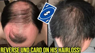 HE PULLED A REVERSE UNO CARD ON HIS HAIR LOSS! **INCREDIBLE TRANSFORMATION**