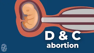 About D&C Abortion (Dilation and Curettage)