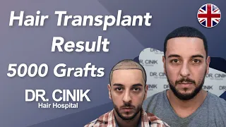 Hair Transplant Results with 5000 Grafts - Before and After | Dr. Emrah Cinik