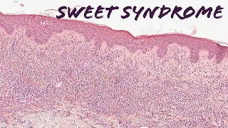 Sweet syndrome explained in 5 minutes (pathology histology dermatology dermpath USMLE)