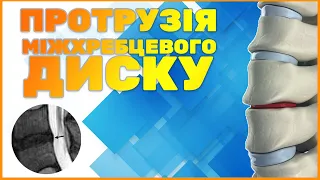 Що таке протрузія міжхребцевого диску? // Что такое протрузия?