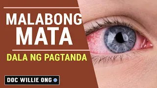Malabong Mata: Dala ng Pagtanda - Payo ni Doc Liza Ong #261b