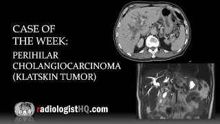 Case of the Week: Perihilar Cholangiocarcinoma/Klatskin Tumor (CT & MRI)