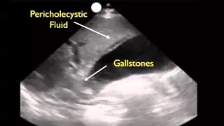 How To: Gallbladder Ultrasound Part 3 - Acute Cholecystitis Case Study Video
