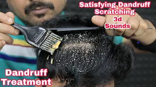 Satisfying Dandruff Scratching ASMR Dandruff Treatment by biswajit barber