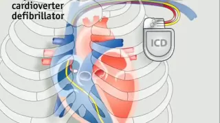 How pacemakers work