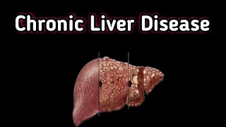 Management of Chronic Liver Disease in ED