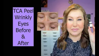 TCA Peel for Eyelids - Before & After, Demo - Wrinkly/Mature Eyes
