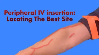 Peripheral IV Insertion: Locating the Best Site