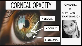 Corneal Opacity -  Grading & Clinical Examination | Adherent Leucoma| Nebular, Macular & Leucomatous