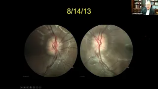 OCT for Neuro Ophthalmic Disorders