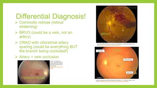 iPiece BRAO and Carotid Artery Disease Part 2