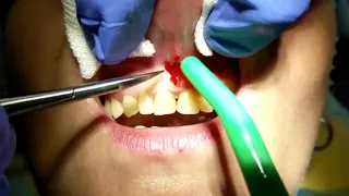 Коррекция уздечки на верхней губе
