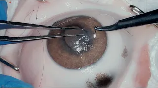 Cornea Suture 101