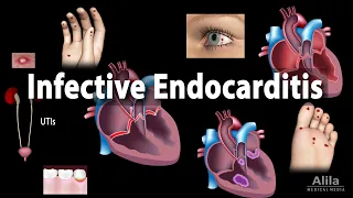 Infective Endocarditis, Animation