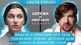 СВЕТА УГОЛЁК | МОДЕЛЬ С ОЖОГАМИ 50% ТЕЛА | ПОИСК И ПРИНЯТИЕ СЕБЯ