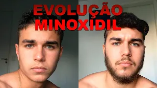 EVOLUÇÃO MINOXIDIL (2022/2023)