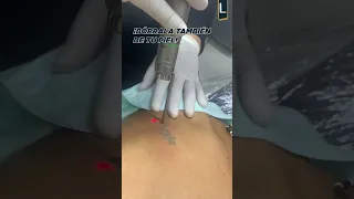 Atenua ese tatuaje para que cierres esa etapa