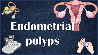 Endometrial (Uterine) Polyps - Everything You Need To Know