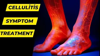 Cellulitis: Causes, Symptoms, Treatment and Prevention - Health Go