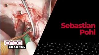 Treatment of peri-implantitis electrolytic cleaning w/ Sebastian Pohl | Clinical Video