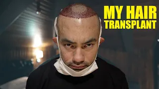 MY HAIR LOSS JOURNEY | GETTING A HAIR TRANSPLANT IN TURKEY | DHI TRANSPLANT