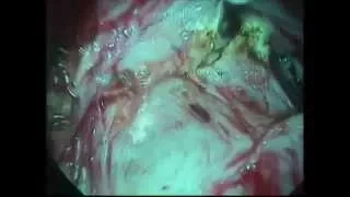Миомэктомия после ФУЗ аблации.Роды -кесарево сечение.