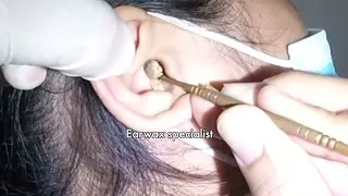 Woman's Massive Dry Earwax Removal