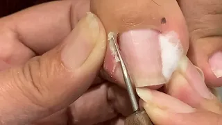 deep leg skin cutting technique#