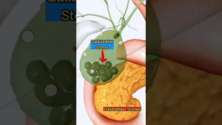 Gallbladder Stones 3D Animation |Medical| #3d #medical