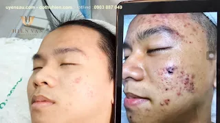 Review khách hàng tại Hien van spa.Review Client after treatment process, blackhead extraction,acne.