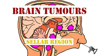 Tumours of the Sellar Region