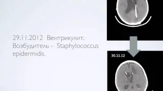 Эпилептический синдром в нейрореанимации