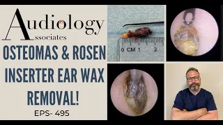 OSTEOMAS & ROSEN INSERTER EAR WAX REMOVAL - EP495