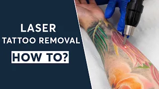 HOW TO: Remove A Tattoo With Laser Tattoo Removal | London