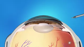 What is Refractive Lens Exchange Surgery?