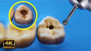AWESOME cavities being removed in HIGH 4K magnification