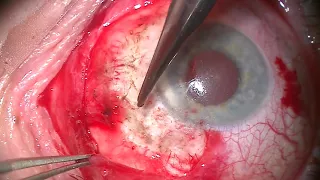 Management of Conjunctival Melanoma