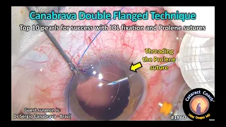 CataractCoach™ 1860: Canabrava double flanged technique for IOL fixation