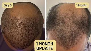 1 Month Update for Hair Transplant