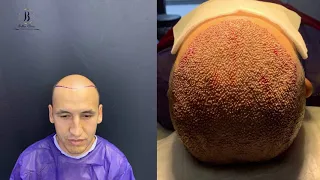 пересадка волос - 5.500 графтов за один сеанс / 5.500 grafts hair transplant per one session