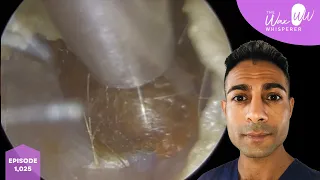 1,025 - Fully Occluding Ear Wax Removal